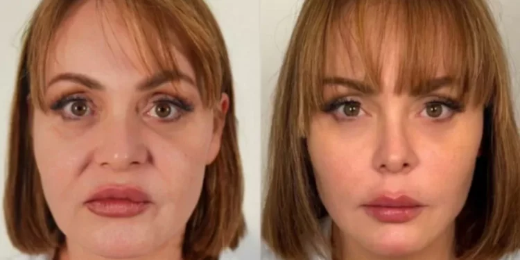 Gaby Spanic, de Usurpadora, surge irreconhecível após harmonização facial